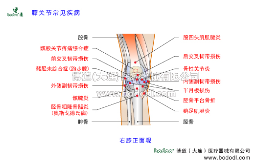 膝關(guān)節(jié)常見(jiàn)疾病及其預(yù)防與治療，膝關(guān)節(jié)半月板損傷，髕前滑囊炎髕腱炎跳躍膝，髕股關(guān)節(jié)炎，博道醫(yī)用膝關(guān)節(jié)固定帶，髕股關(guān)節(jié)綜合證髕骨軟化癥髕骨脫位，膝關(guān)節(jié)滑膜炎骨性關(guān)節(jié)炎滑囊炎，髂脛束綜合征跑步膝，半月板損傷，交叉十字韌帶內(nèi)側(cè)外側(cè)副韌帶損傷，脛股粗隆骨骺病脛骨結(jié)節(jié)軟骨病骨骺炎奧斯戈德氏病生長(zhǎng)痛，髕下滑囊炎髕下脂肪墊損傷鵝足肌腱炎右膝正面觀，膝關(guān)節(jié)可調(diào)式卡盤(pán)固定護(hù)膝支架，膝關(guān)節(jié)置換脛骨平臺(tái)骨折髕骨骨折固定支架