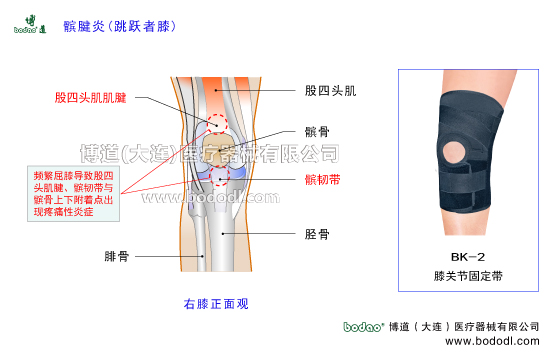 髕腱炎跳躍者，膝股四頭肌肌腱炎，博道髕腱加壓固定帶，透氣性膝關(guān)節(jié)加壓固定帶JK帶膝關(guān)節(jié)固定帶BK-2髕腱炎加壓護(hù)膝排行榜，臏腱炎跳躍者膝股四頭肌腱炎的病因與預(yù)防治療，肌腱炎加壓固定帶哪家好。膝關(guān)節(jié)常見(jiàn)疾病博道透氣護(hù)膝戶外運(yùn)動(dòng)矯形保暖護(hù)膝，股骨髕骨臏腱髕韌帶脛骨滑膜膝關(guān)節(jié)囊，膝關(guān)節(jié)矯正帶髕前韌帶髕下韌帶，髕韌帶長(zhǎng)度及主要功能與作用，膝關(guān)節(jié)伸膝裝置與屈膝裝置。髕腱炎是長(zhǎng)期勞損引起髕韌帶上下附著點(diǎn)出現(xiàn)疼痛