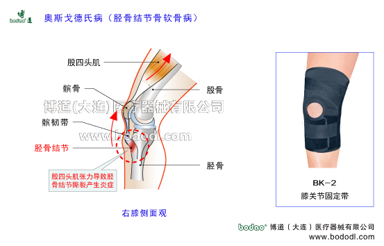 奧斯戈德氏病Osgood-Schlatter病脛骨結(jié)節(jié)骨軟骨病的主要癥狀脛骨粗隆骨骺炎的原因與治療方法癥狀生長(zhǎng)痛的原因癥狀與加壓矯正護(hù)膝脛骨結(jié)節(jié)軟骨病的癥狀與加壓防護(hù)及治療方法脛骨粗隆骨骺炎的癥狀與加壓固定治療跳躍者膝股四頭肌肌腱炎膝關(guān)節(jié)伸膝裝置矯正固定帶膝關(guān)節(jié)固定帶BK-2膝關(guān)節(jié)常見(jiàn)疾病博道運(yùn)動(dòng)保暖護(hù)膝股四頭肌腱臏腱髕韌帶日本透氣護(hù)膝膝關(guān)節(jié)韌帶軟骨損傷矯形固定支具脛骨結(jié)節(jié)骨骺疾病的原因與治療O型腿
