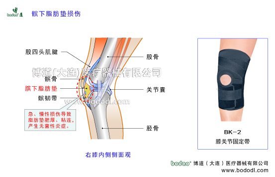 髕下脂肪墊損傷髕下脂肪墊炎Hoffa病脂肪墊勞損脂肪墊損傷，髕下脂肪墊損傷的主要癥狀與康復(fù)治療，博道透氣性醫(yī)用護(hù)膝膝關(guān)節(jié)固定帶BK-2，膝關(guān)節(jié)常見(jiàn)疾病，博道戶外運(yùn)動(dòng)透氣性加壓護(hù)膝排行榜，矯形保暖護(hù)膝股骨股四頭肌腱髕骨韌帶損傷臏腱髕韌帶膝關(guān)節(jié)囊膝關(guān)節(jié)軟組織損傷固定支具髕下脂肪墊的形狀和功能膝關(guān)節(jié)囊內(nèi)呈三角形脂肪組織翼狀皺襞。髕下脂肪墊具有加強(qiáng)膝關(guān)節(jié)穩(wěn)定潤(rùn)滑關(guān)節(jié)組織和減少髕骨髕韌帶與關(guān)節(jié)囊骨關(guān)節(jié)面的摩擦