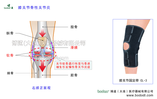 膝關(guān)節(jié)骨性關(guān)節(jié)炎發(fā)病原因OA、Osteoarthrosis膝關(guān)節(jié)退行性關(guān)節(jié)病膝關(guān)節(jié)增生性骨關(guān)節(jié)炎繼發(fā)性膝關(guān)節(jié)骨性關(guān)節(jié)炎和原發(fā)性膝關(guān)節(jié)骨性關(guān)節(jié)炎膝關(guān)節(jié)炎保暖矯形護(hù)膝關(guān)節(jié)軟骨防護(hù)固定護(hù)膝膝關(guān)節(jié)骨質(zhì)增生矯正固定帶膝關(guān)節(jié)慢性關(guān)節(jié)炎矯形固定帶護(hù)膝膝關(guān)節(jié)骨性關(guān)節(jié)炎的主要癥狀與治療護(hù)理，博道透氣性醫(yī)用護(hù)膝排名，膝關(guān)節(jié)固定帶哪家好CL-3膝關(guān)節(jié)常見(jiàn)疾病博道保暖護(hù)膝膝關(guān)節(jié)軟骨滑膜膝關(guān)節(jié)囊，日本透氣護(hù)膝膝關(guān)節(jié)軟組織損傷
