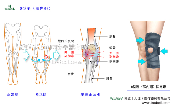 O型腿羅圈腿膝內(nèi)翻下肢畸形疾病。膝關(guān)節(jié)的構(gòu)造，O型腿膝內(nèi)翻的病因、癥狀及治療方法。O型腿膝內(nèi)翻的危害與預(yù)防治療。O型腿膝內(nèi)翻的保守治療與手術(shù)治療及康復(fù)護(hù)理。膝關(guān)節(jié)退行性骨性關(guān)節(jié)炎。博道O型腿膝內(nèi)翻專用透氣性醫(yī)用護(hù)膝排名，膝關(guān)節(jié)加壓固定帶矯形保暖護(hù)膝日本透氣護(hù)膝膝關(guān)節(jié)固定矯形支架膝關(guān)節(jié)內(nèi)側(cè)半月板內(nèi)側(cè)副韌帶，膝關(guān)節(jié)外側(cè)半月板外側(cè)副韌帶的矯正固定。女性O(shè)型腿膝內(nèi)翻患病率多于男性的原因。