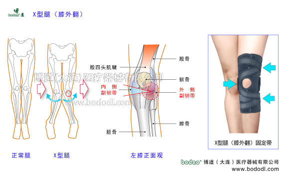 X型腿膝外翻下肢畸形疾病。膝關(guān)節(jié)的構(gòu)造，X型腿膝外翻的發(fā)病原因、癥狀及治療方法。X型腿膝外翻的危害與治療方法。X型腿膝外翻的保守治療與手術(shù)治療及康復(fù)護(hù)理。膝關(guān)節(jié)退行性骨性關(guān)節(jié)炎。博道X型腿膝外翻專用加壓矯形護(hù)膝，膝關(guān)節(jié)加壓固定帶矯形保暖護(hù)膝日本透氣護(hù)膝膝關(guān)節(jié)固定矯形支架膝關(guān)節(jié)內(nèi)側(cè)半月板內(nèi)側(cè)副韌帶的矯正固定，膝關(guān)節(jié)外側(cè)半月板外側(cè)副韌帶的矯正固定。女性X型腿膝外翻患病率多于男性的原因。