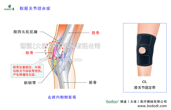 髕股關(guān)節(jié)疼痛綜合癥的病因及癥狀PFPS髕骨軟化癥專用加壓護(hù)膝髕骨脫位膝關(guān)節(jié)退行性關(guān)節(jié)病膝關(guān)節(jié)增生性骨關(guān)節(jié)炎博道透氣性膝關(guān)節(jié)固定帶CL-1膝關(guān)節(jié)常見(jiàn)疾病矯形保暖護(hù)膝膝關(guān)節(jié)軟骨髕韌帶股四頭肌腱右膝側(cè)面觀膝關(guān)節(jié)矯正帶髕股關(guān)節(jié)主要功能是確保膝關(guān)節(jié)屈伸時(shí)髕骨在股骨髁間切跡中上下滑動(dòng)完成屈伸跳躍等動(dòng)作髕股關(guān)節(jié)的穩(wěn)定性主要依靠股四頭肌腱髕骨髂脛束和股內(nèi)側(cè)斜肌的動(dòng)力性因素也依靠膝關(guān)節(jié)囊股骨髁髕骨內(nèi)外側(cè)支持帶和臏股韌