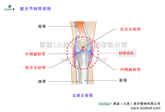 膝關(guān)節(jié)韌帶損傷膝關(guān)節(jié)韌帶的構(gòu)造與作用內(nèi)側(cè)副韌帶MCL外側(cè)副韌帶LCL前后交叉韌帶前后十字韌帶ACL損傷PCL損傷。博道膝關(guān)節(jié)固定帶醫(yī)用護(hù)膝膝關(guān)節(jié)角度可調(diào)式卡盤(pán)固定支架膝關(guān)節(jié)韌帶撕脫性骨折固定夾板透氣性加壓護(hù)膝。膝關(guān)節(jié)韌帶是膝關(guān)節(jié)重要穩(wěn)定因素具有限制和制導(dǎo)功能當(dāng)韌帶承受的應(yīng)力超過(guò)其完全斷裂的屈服點(diǎn)后則發(fā)生韌帶部分?jǐn)嗔淹耆珨嗔押吐?lián)合性損傷等撕裂損傷韌帶損傷類型和部位撕脫性骨折。