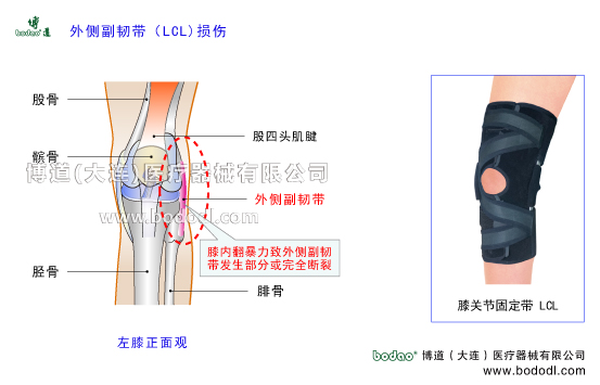 膝關(guān)節(jié)外側(cè)副韌帶損傷的原因、癥狀與康復(fù)治療。博道透氣性膝關(guān)節(jié)外側(cè)副韌帶LCL固定帶，膝關(guān)節(jié)損傷固定支具O型腿矯正固定X型腿矯正固定膝關(guān)節(jié)骨質(zhì)增生內(nèi)側(cè)半月板損傷斷裂矯正康復(fù)固定，外側(cè)半月板損傷斷裂矯正與康復(fù)固定膝關(guān)節(jié)外傷護(hù)膝支架支具哪家好。膝關(guān)節(jié)加壓固定帶排行榜博道LCL加壓護(hù)膝關(guān)節(jié)外側(cè)副韌帶損傷固定帶膝關(guān)節(jié)LCL損傷的預(yù)防與治療膝關(guān)節(jié)外側(cè)副韌帶損傷可調(diào)節(jié)式固定夾板LCL外側(cè)副韌帶重建固定支架