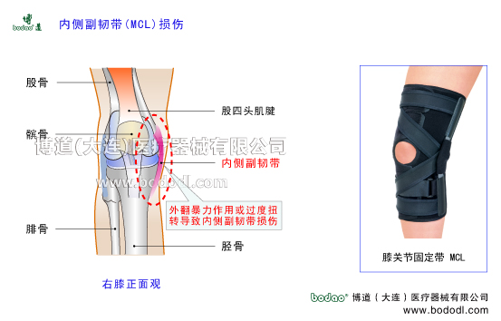 膝關(guān)節(jié)內(nèi)側(cè)副韌帶MCL的構(gòu)造與功能，膝內(nèi)側(cè)副韌帶損傷的原因與康復(fù)治療，博道膝關(guān)節(jié)軟組織損傷固定矯正支架O型膝內(nèi)翻X型腿膝外翻矯正固定護(hù)膝哪個(gè)好，膝關(guān)節(jié)內(nèi)側(cè)外側(cè)半月板損傷斷裂固定護(hù)膝，半月板損傷斷裂治療與術(shù)后固定。博道內(nèi)側(cè)副韌帶MCL固定帶MCL加壓護(hù)膝排行榜，膝關(guān)節(jié)MCL損傷術(shù)后固定與康復(fù)護(hù)理，MCL內(nèi)側(cè)副韌帶損傷防護(hù)固定夾板MCL內(nèi)側(cè)副韌帶重建固定矯正支架，內(nèi)側(cè)副韌帶損傷可調(diào)節(jié)式固定護(hù)膝夾板哪個(gè)好