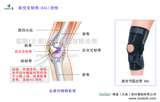膝關(guān)節(jié)前交叉韌帶ACL損傷的原因、癥狀及治療方法。博道膝關(guān)節(jié)醫(yī)用固定帶膝關(guān)節(jié)ACL前交叉韌帶損傷斷裂的治療與護(hù)理可調(diào)節(jié)式膝關(guān)節(jié)前交叉韌帶固定夾板膝關(guān)節(jié)軟組織損傷固定矯正支架膝關(guān)節(jié)骨質(zhì)增生膝關(guān)節(jié)外傷等防護(hù)與術(shù)后固定護(hù)膝博道加壓護(hù)膝前十字ACL韌帶損傷固定帶膝關(guān)節(jié)ACL前交叉韌帶前十字韌帶損傷防護(hù)固定膝關(guān)節(jié)的構(gòu)造ACL前交叉韌帶前十字韌帶重建康復(fù)固定膝關(guān)節(jié)疾病的預(yù)防與治療膝關(guān)節(jié)疾病的治療與康復(fù)護(hù)理博道加