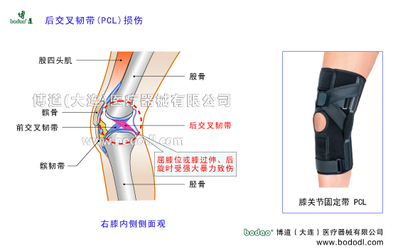 膝關(guān)節(jié)后交叉韌帶PCL的構(gòu)造與功能。后交叉韌帶損傷的原因、癥狀及治療方法。博道后交叉韌帶損傷加壓固定帶日本透氣護(hù)膝膝關(guān)節(jié)PCL后交叉韌帶損傷斷裂的主要癥狀與康復(fù)治療?？烧{(diào)式膝關(guān)節(jié)韌帶固定支架膝關(guān)節(jié)軟組織損傷固定夾板膝關(guān)節(jié)增生性關(guān)節(jié)炎膝關(guān)節(jié)損傷的防護(hù)與術(shù)后固定護(hù)理博道透氣性加壓護(hù)膝后十字韌帶損傷醫(yī)用固定帶PCL損傷固定帶膝關(guān)節(jié)的構(gòu)造PCL后交叉韌帶后十字韌帶重建固定膝關(guān)節(jié)疾病的預(yù)防與治療膝關(guān)節(jié)疾病的治