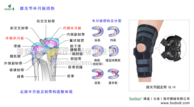 膝關(guān)節(jié)半月板損傷膝關(guān)節(jié)半月板及韌帶構(gòu)造。膝關(guān)節(jié)韌帶半月板關(guān)節(jié)囊滑膜骨骼解剖圖。半月板損傷分型。博道膝關(guān)節(jié)可調(diào)節(jié)式卡盤(pán)固定支架膝關(guān)節(jié)骨折可調(diào)式固定支架CL-H內(nèi)側(cè)半月板外側(cè)半月板及韌帶構(gòu)造髕韌帶髕下脂肪墊翼狀皺襞髕下滑膜皺襞脛骨粗隆脛骨外側(cè)副韌帶腘肌腱腓骨膝橫韌帶后交叉韌帶內(nèi)側(cè)副韌帶膝關(guān)節(jié)囊膝關(guān)節(jié)滑膜前交叉韌帶半月板損傷的原因、癥狀及治療方法?？烧{(diào)式膝關(guān)節(jié)固定帶腿部下肢骨折固定夾板半月板損傷的主要癥狀