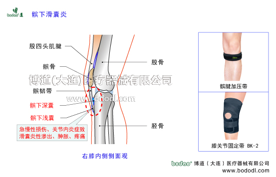 髕下滑囊炎膝關(guān)節(jié)髕下滑囊炎的病因癥狀與防護(hù)治療方法。髕下深囊脛骨粗隆腱下囊髕下滑囊炎的防護(hù)與治療。髕下滑囊的構(gòu)造與功能。髕下淺囊皮下囊及脛骨粗隆皮下囊。股四頭肌腱。膝關(guān)節(jié)髕下滑囊炎的癥狀與博道膝關(guān)節(jié)固定帶的防護(hù)功能，髕腱加壓帶JK帶可調(diào)式膝關(guān)節(jié)卡盤(pán)固定支架透氣性醫(yī)用護(hù)膝，下肢腿部術(shù)后固定夾板日本護(hù)膝腿部骨折固定夾板。醫(yī)用加壓護(hù)膝BK-2具有減輕膝關(guān)節(jié)壓力和摩擦、增加襯墊和滑動(dòng)、保護(hù)髕韌帶與脛骨免于相