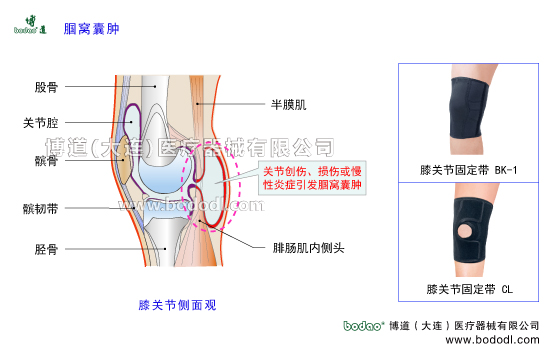 腘窩囊腫，貝克囊、Baker\'s cyst膝關(guān)節(jié)構(gòu)造，膝關(guān)節(jié)腔的結(jié)構(gòu)，股骨脛骨髕骨的構(gòu)造，博道醫(yī)用膝關(guān)節(jié)固定帶BK-1、CL-1透氣性醫(yī)用加壓護(hù)膝的防護(hù)效果，腘窩囊腫的病因、癥狀及康復(fù)治療與護(hù)理，腘窩囊腫加壓固定帶，膝關(guān)節(jié)角度可調(diào)式卡盤(pán)固定支架半月板損傷固定支具戶外運(yùn)動(dòng)加壓護(hù)膝，膝蓋骨折固定夾板日本透氣護(hù)膝，膝關(guān)節(jié)韌帶軟骨等軟組織損傷康復(fù)固定夾板，下肢腿部術(shù)后固定夾板，股骨髕骨脛骨腓骨骨折專業(yè)固定夾