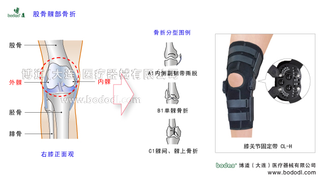 股骨髁部骨折，膝關(guān)節(jié)的結(jié)構(gòu)，博道角度可調(diào)式卡盤(pán)固定支架，膝關(guān)節(jié)內(nèi)骨折的分類及特點(diǎn)，博道醫(yī)用護(hù)膝CL-H股骨髁部骨折的原因、癥狀與術(shù)后治療固定支架，膝關(guān)節(jié)股骨骨折的原因、癥狀、分型與康復(fù)治療。膝關(guān)節(jié)置換固定支架腿部下肢骨折固定夾板，膝關(guān)節(jié)損傷固定支具。膝關(guān)節(jié)區(qū)域骨折專業(yè)固定支架、膝關(guān)節(jié)韌帶重建術(shù)后固定帶、股骨髁部骨折危害脛骨平臺(tái)和髕股關(guān)節(jié)改變膝關(guān)節(jié)正常的解剖軸與機(jī)械軸，導(dǎo)致伸膝裝置粘連、創(chuàng)傷性膝關(guān)節(jié)炎