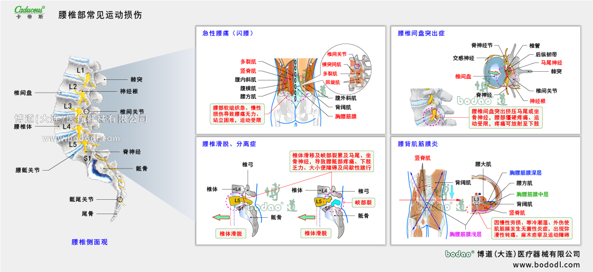 腰椎部運動損傷的類型與癥狀