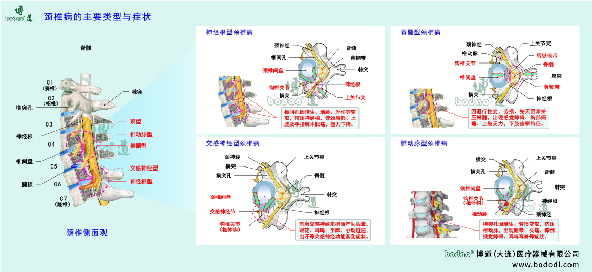 頸椎病的類型與癥狀
