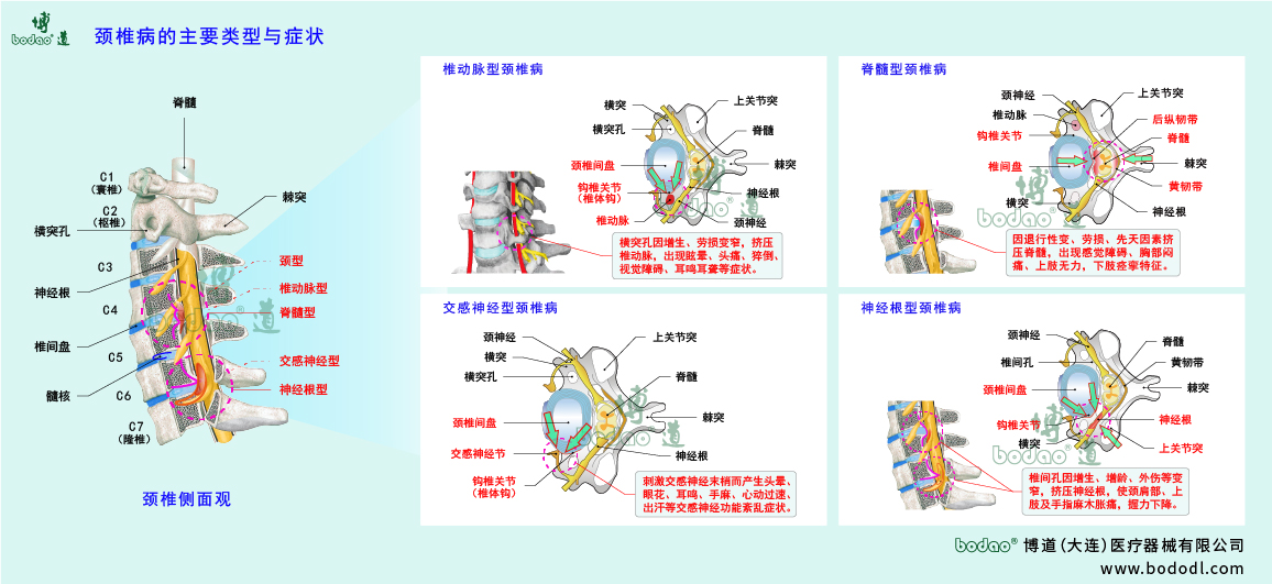 頸椎病的類型與癥狀