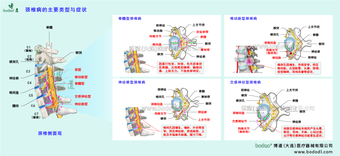 頸椎病的類型與癥狀