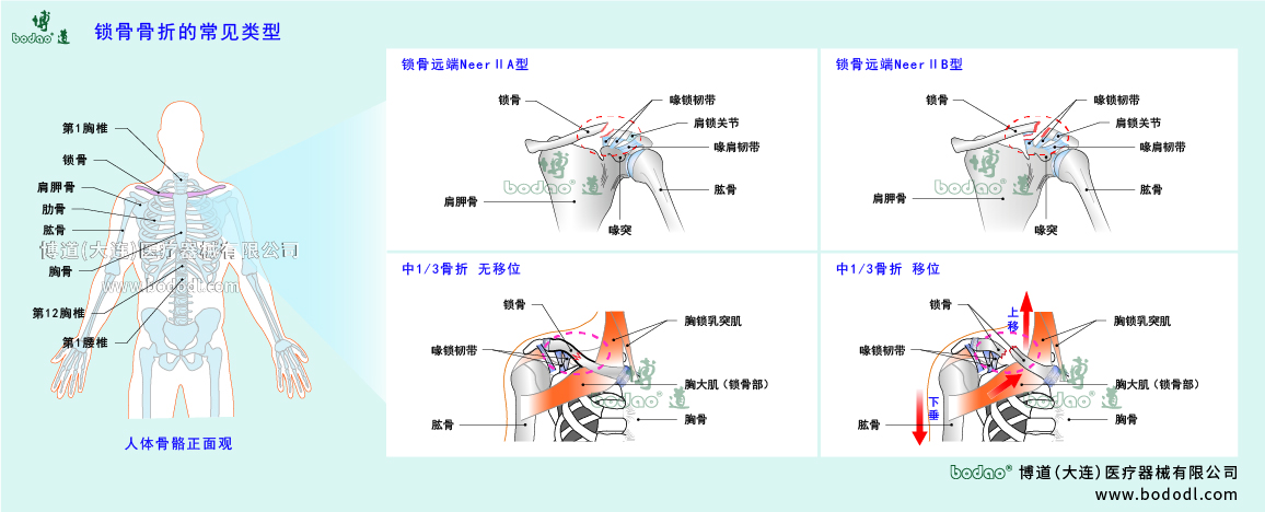 鎖骨傷病的類型與癥狀